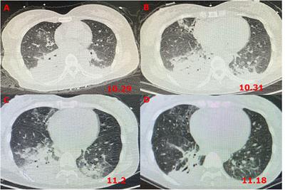 Rapidly progressive Guillain–Barré syndrome following amitriptyline overdose and severe Klebsiella pneumoniae infection: A case report and literature review